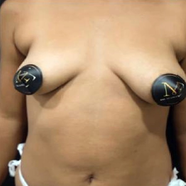 Antes Antes